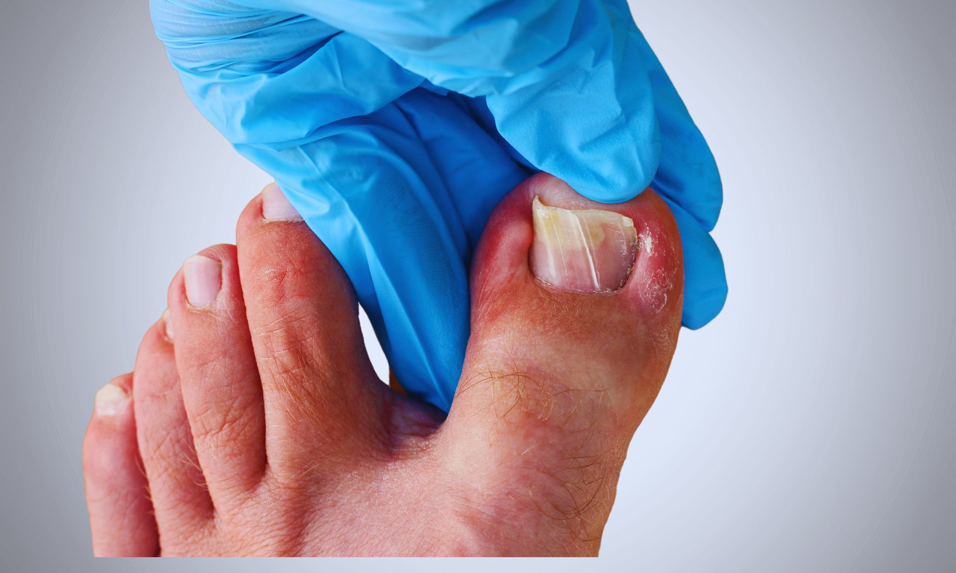 Foot with toenail fungus being examined by a gloved hand. The nail is discolored and thickened.