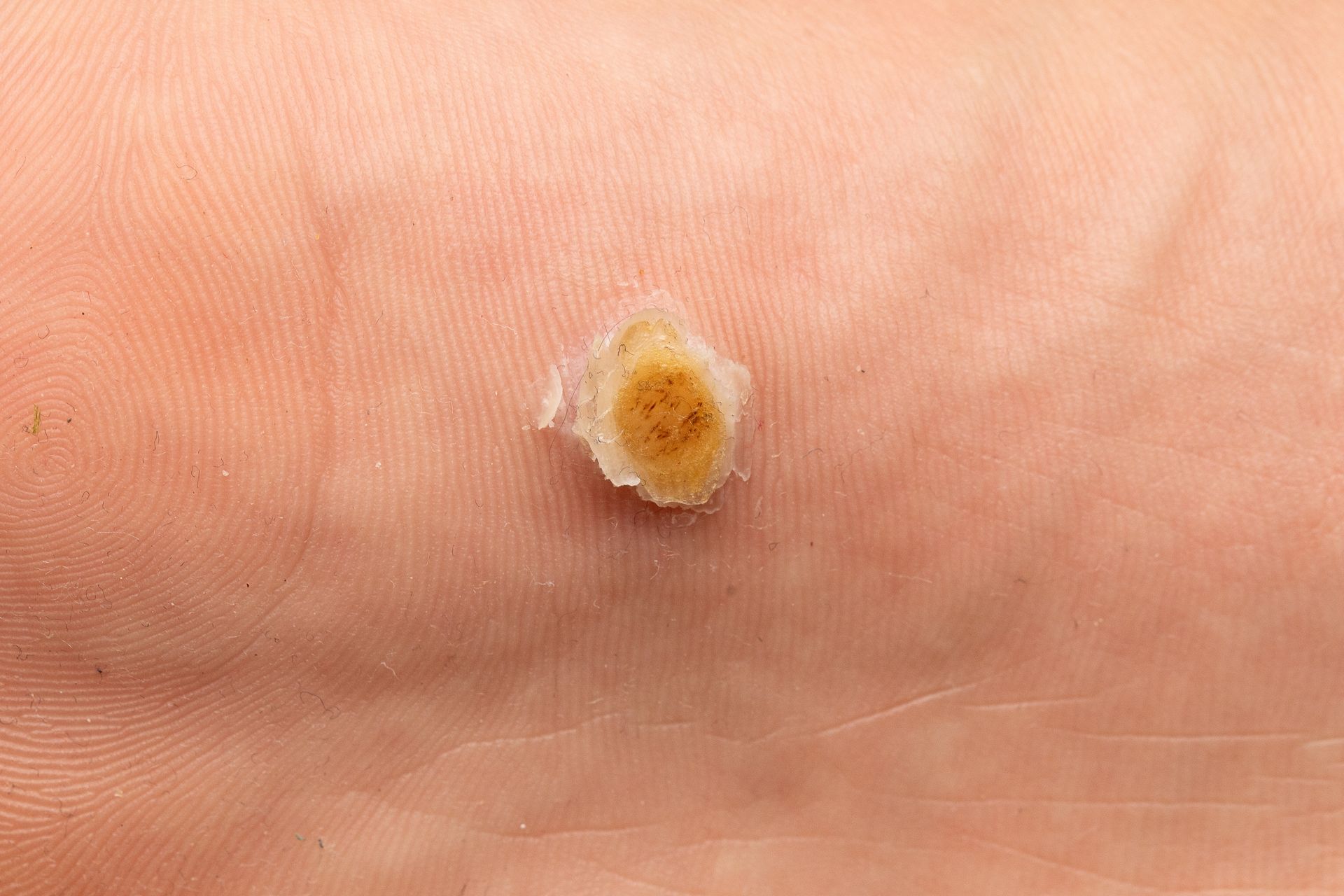 Close-up of a foot with a yellowish plantar wart.