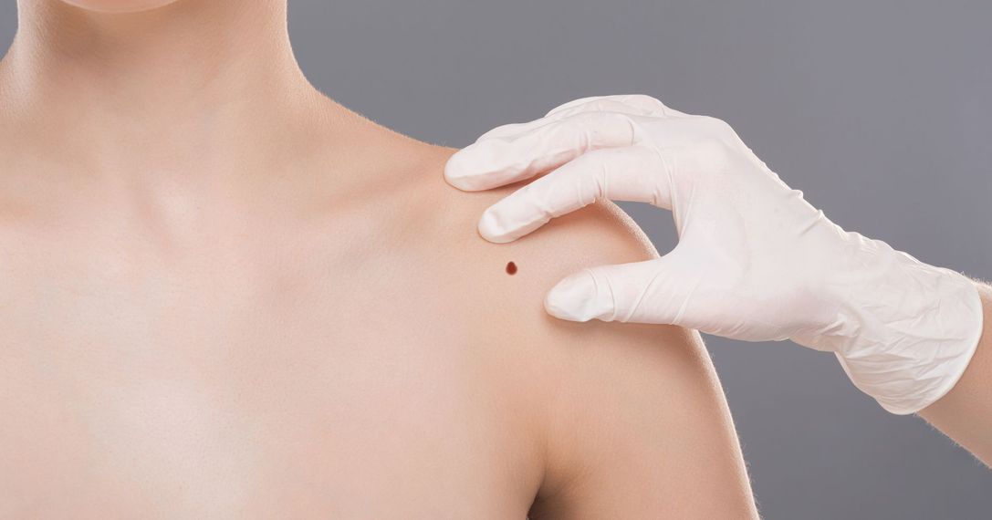 Un medico sta esaminando la spalla di una donna per cercare un neo.