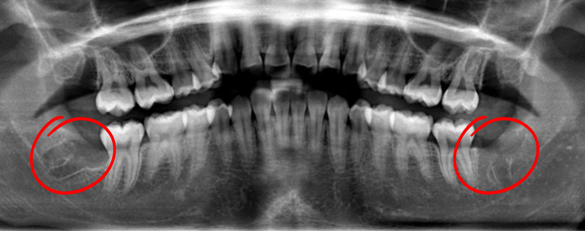 Dental panoramic X-ray showing teeth and jaw with wisdom teeth highlighted in red circles.