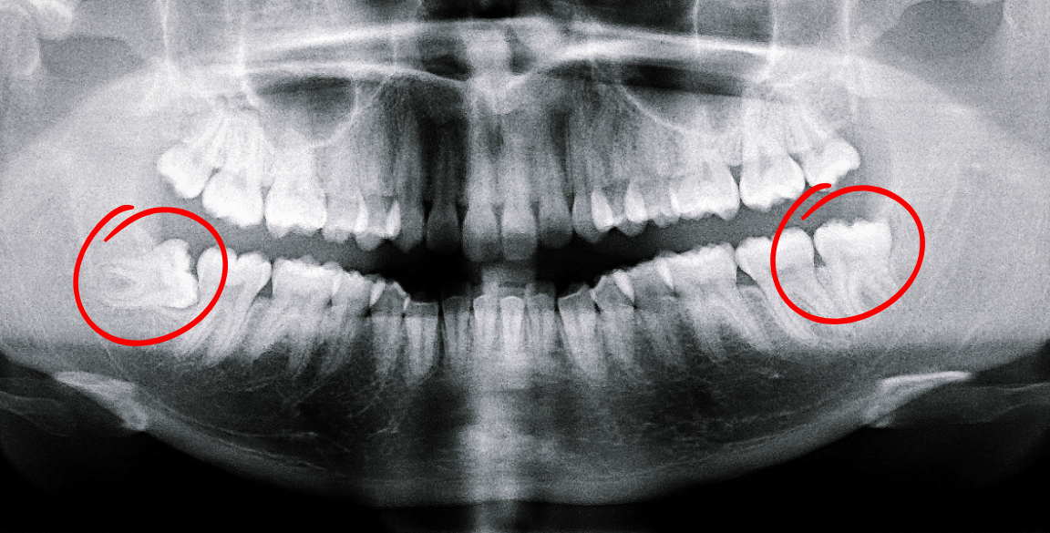 Panoramic dental X-ray shows teeth, with circled wisdom teeth impacted on both sides of the lower jaw.