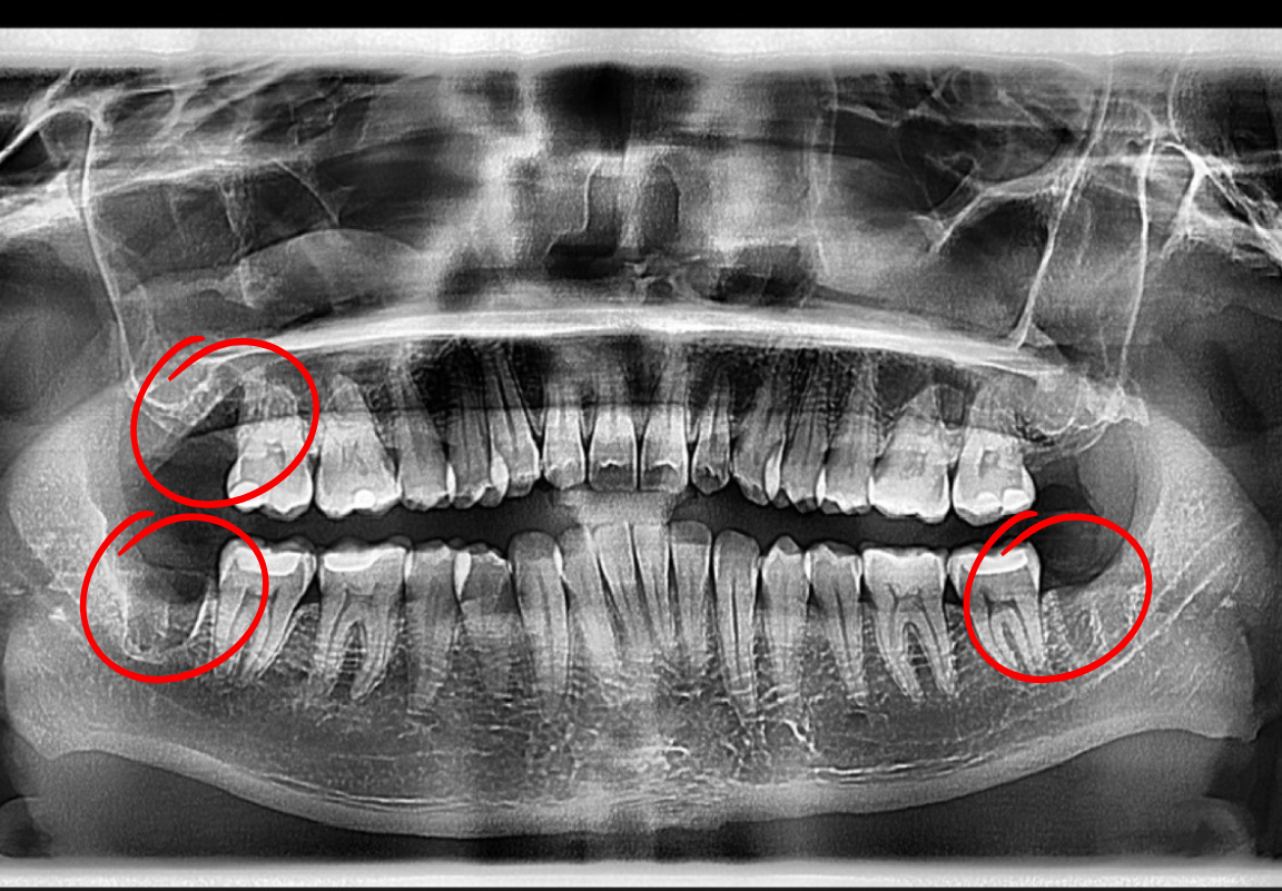 Dental panoramic X-ray showing teeth and jaw with wisdom teeth highlighted in red circles.