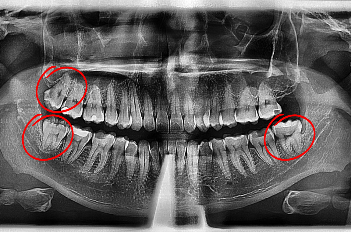 Panoramic dental X-ray shows teeth, with circled wisdom teeth impacted on both sides of the lower jaw.