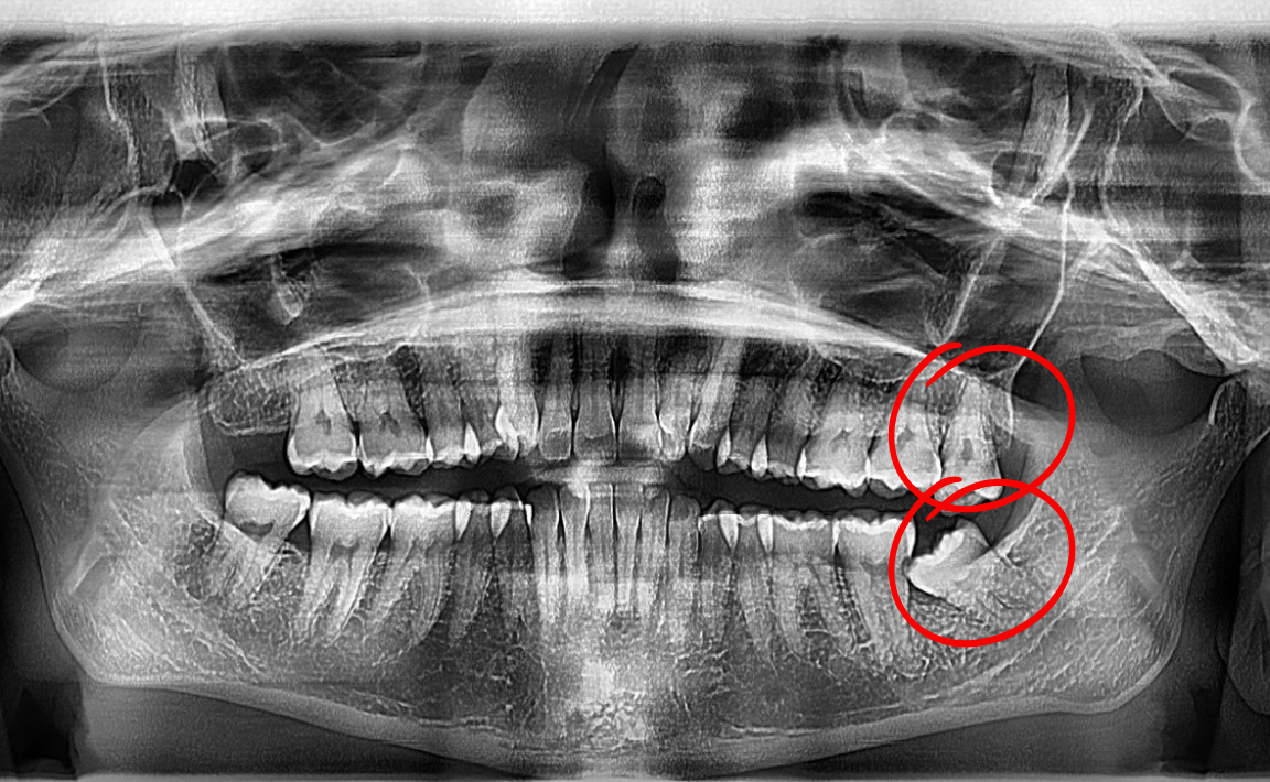 Panoramic dental X-ray with impacted wisdom teeth circled in red.