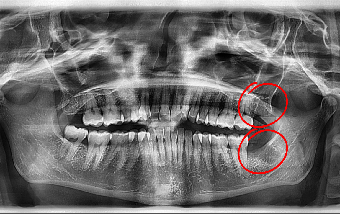 Panoramic dental X-ray of teeth and jaw, with red circles highlighting upper and lower teeth.