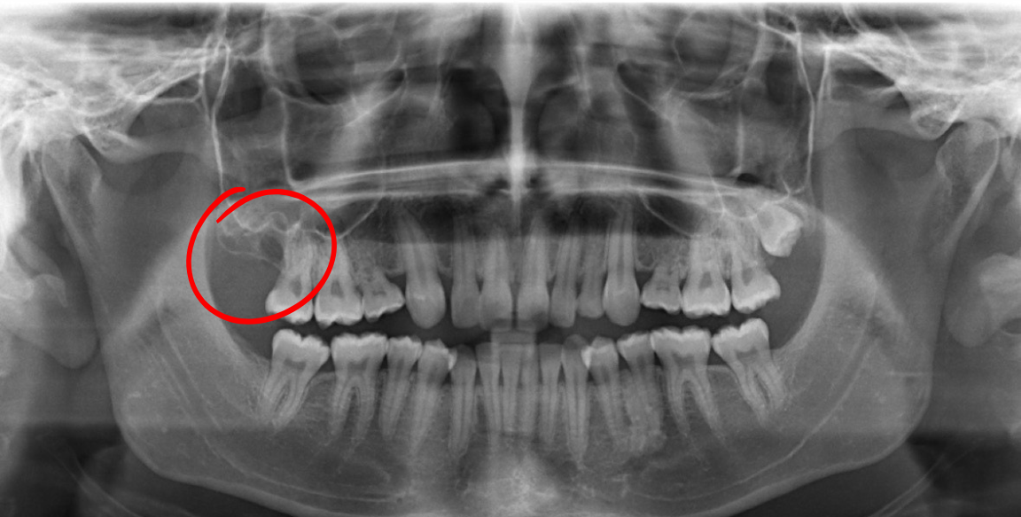 Panoramic dental X-ray; a large, dark, circular area indicates a possible cyst or lesion in the upper jaw.
