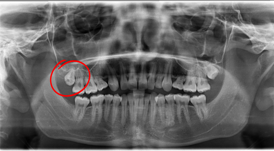 Dental panoramic X-ray showing teeth, with a red circle highlighting an impacted molar.