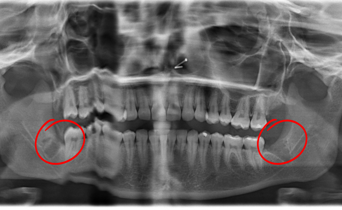 Panoramic dental X-ray showing teeth and jaw. Wisdom teeth highlighted in red circles.