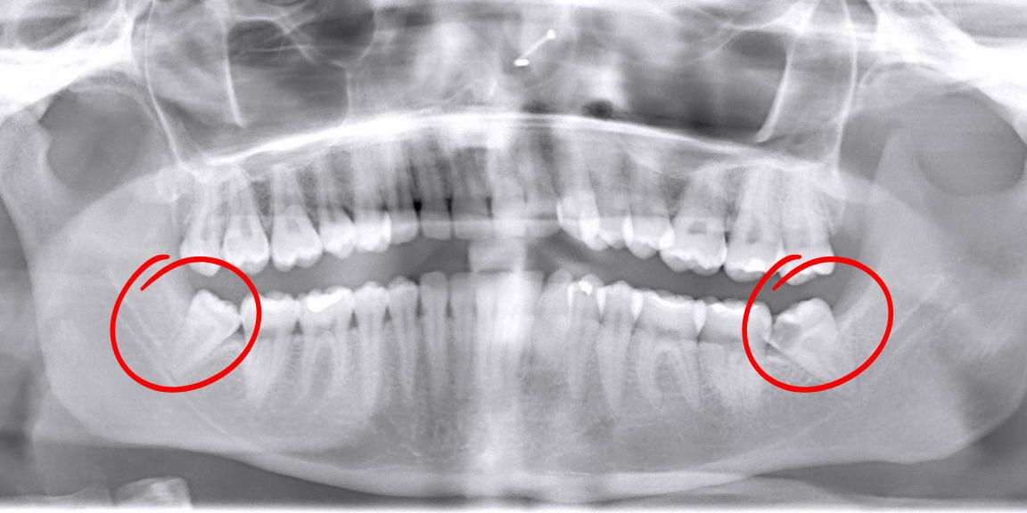 Dental panoramic X-ray with wisdom teeth highlighted by red circles.