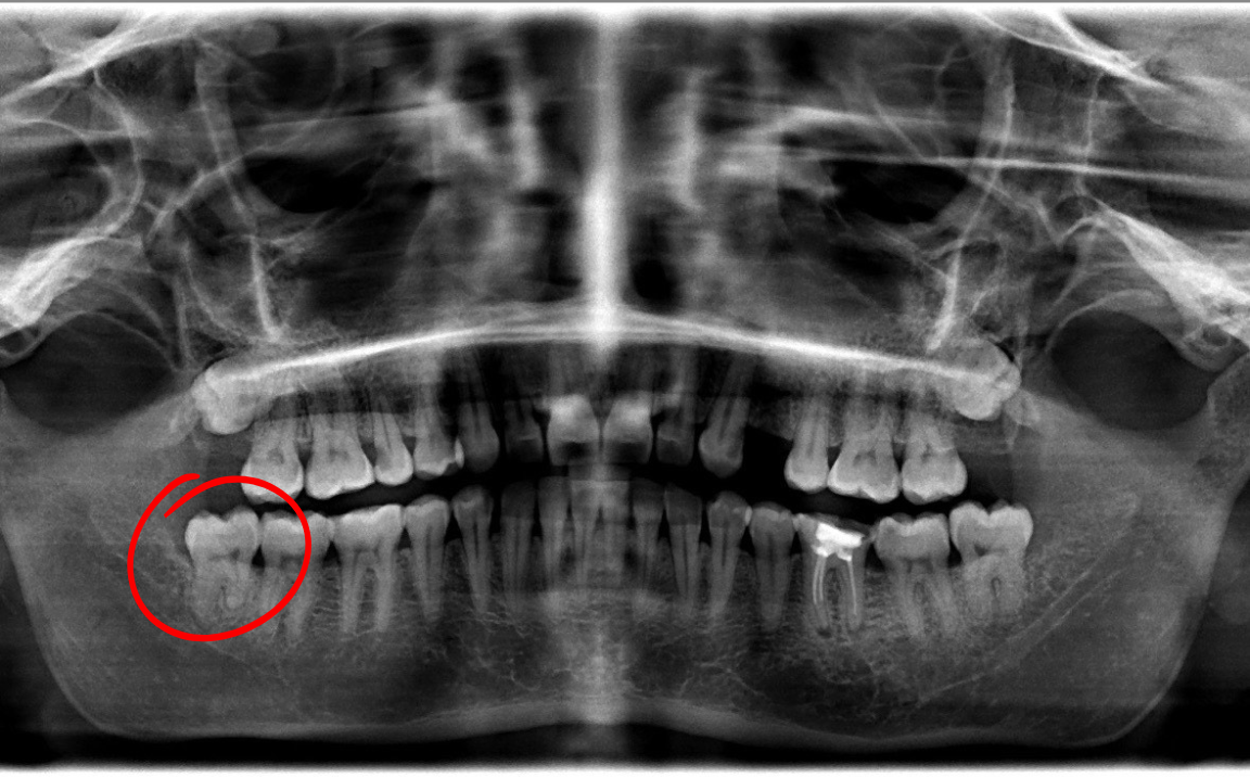 Panoramic dental X-ray; teeth are visible, circled area shows lower molar teeth.