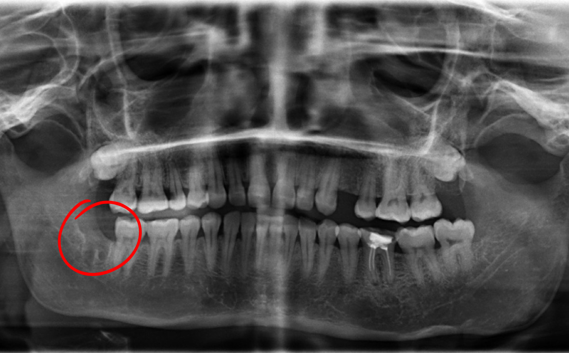 Dental X-ray of jaws; red circle highlights a lower molar with possible issue.