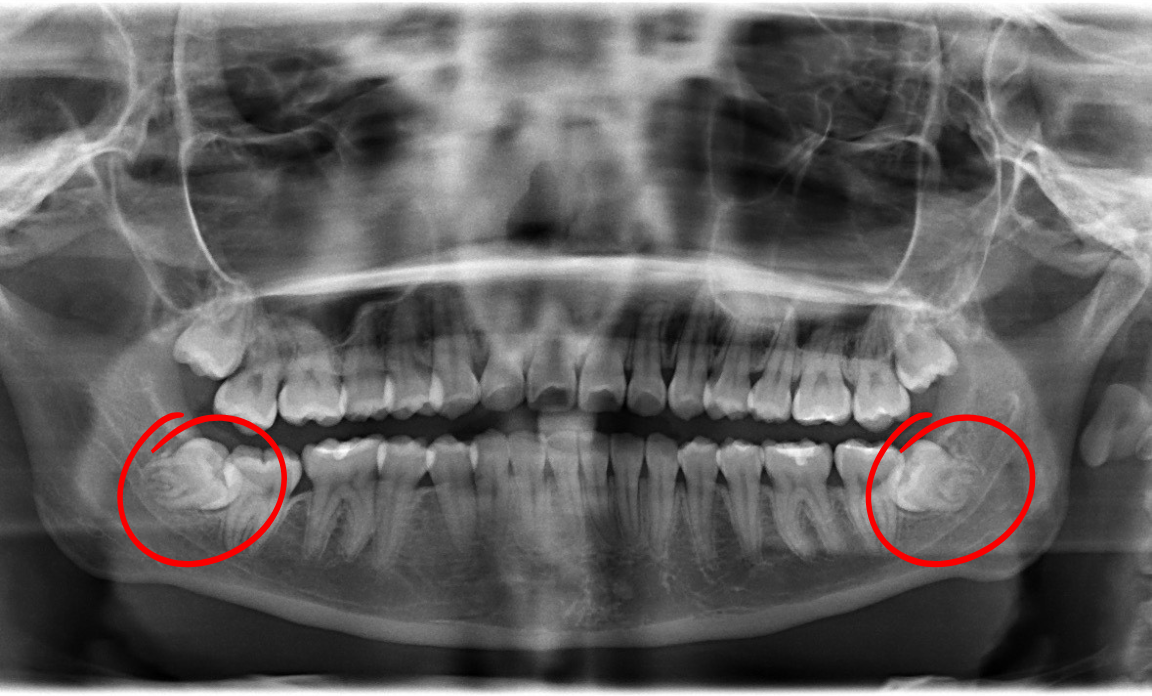 Panoramic dental X-ray showing all teeth, with impacted wisdom teeth circled in red on both sides of the lower jaw.