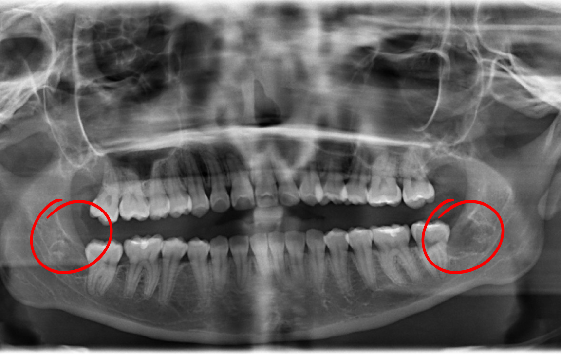 Dental panoramic X-ray showing teeth with red circles highlighting impacted wisdom teeth on both sides of the jaw.