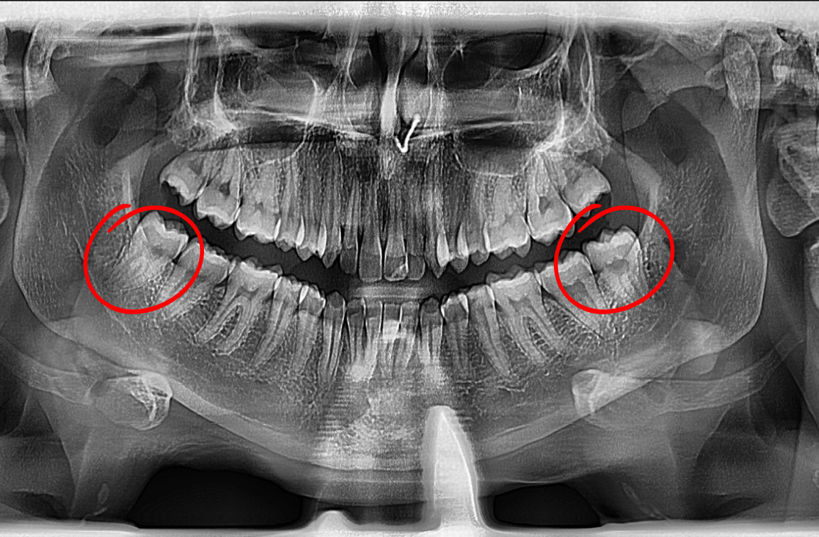 Panoramic dental X-ray highlighting impacted wisdom teeth (circled in red).