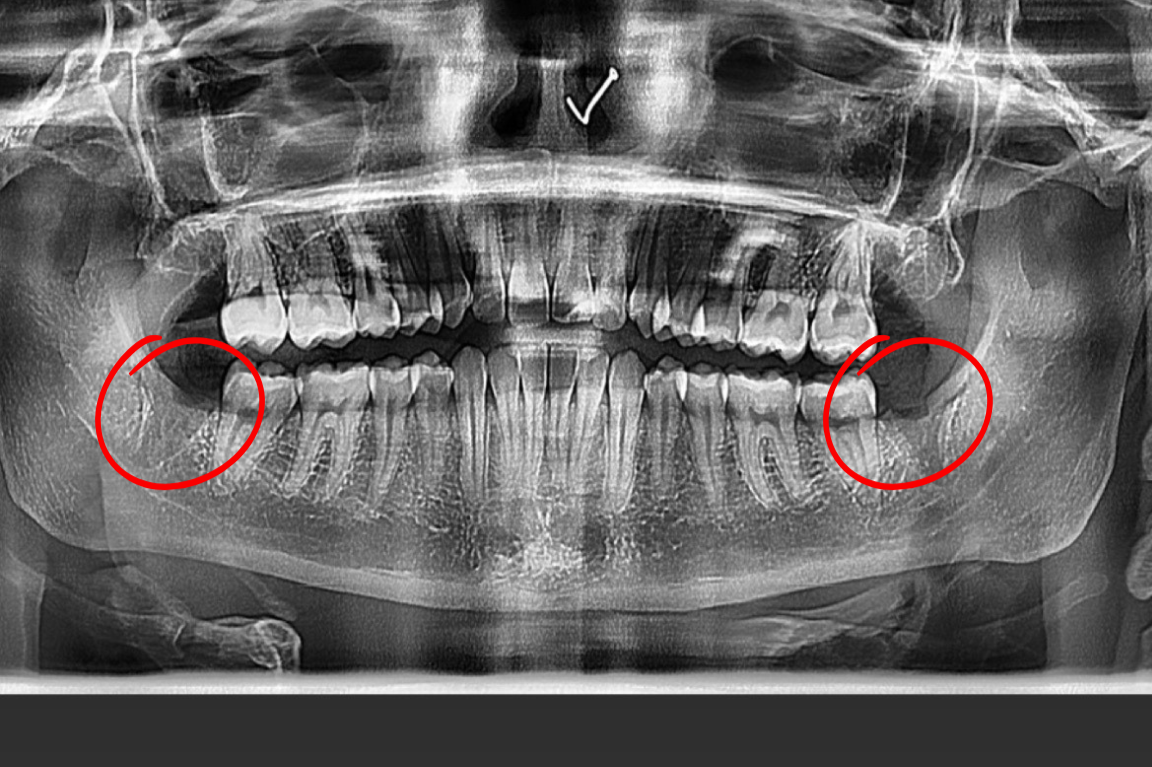 Dental panoramic X-ray with red circles highlighting the mandibular angles on both sides.