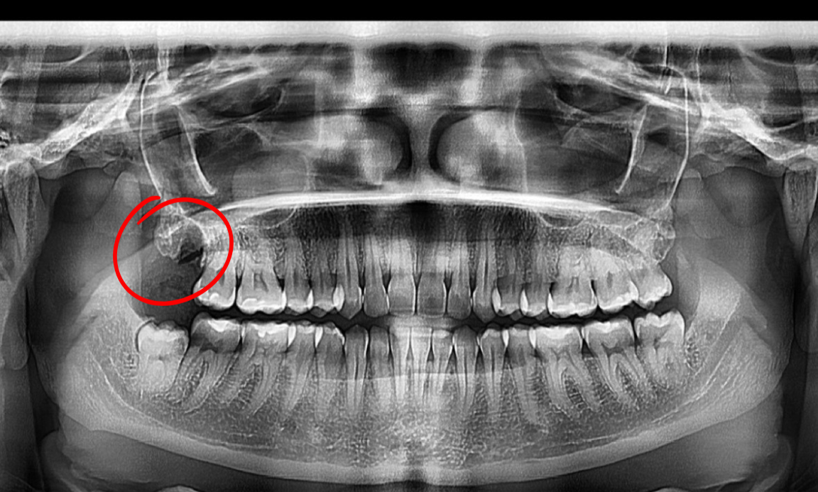 Panoramic dental X-ray showing a tooth with a large cavity, highlighted with a red circle.