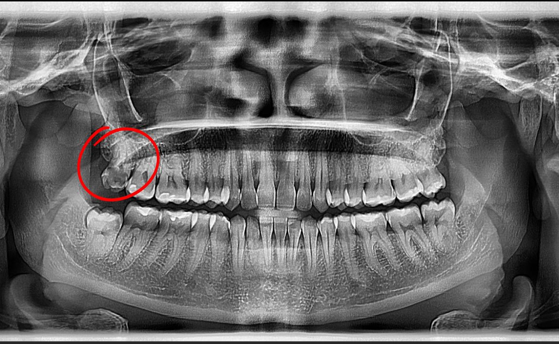 Panoramic dental X-ray; impacted wisdom tooth highlighted with a red circle.