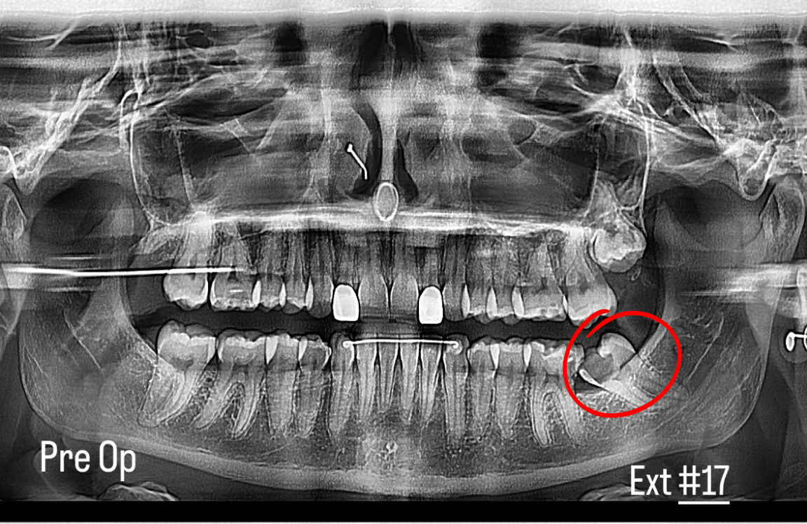 Panoramic dental X-ray shows teeth, with circled wisdom teeth impacted on both sides of the lower jaw.