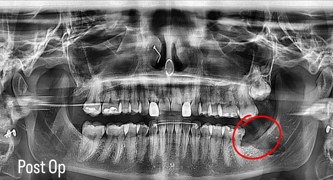 Dental panoramic X-ray showing teeth and jaw with wisdom teeth highlighted in red circles.