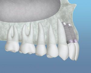 A 3d rendering of a dental implant in a person 's mouth.