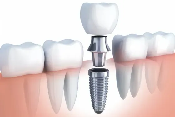 A 3d rendering of a dental implant in a person 's mouth.