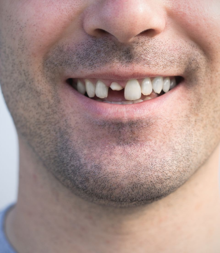 Man smiling with a missing tooth, close-up.