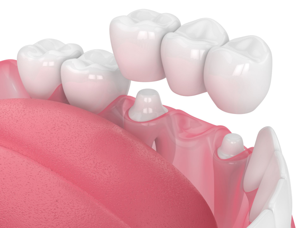 Dental bridge in mouth, replacing a missing tooth, supported by adjacent teeth.