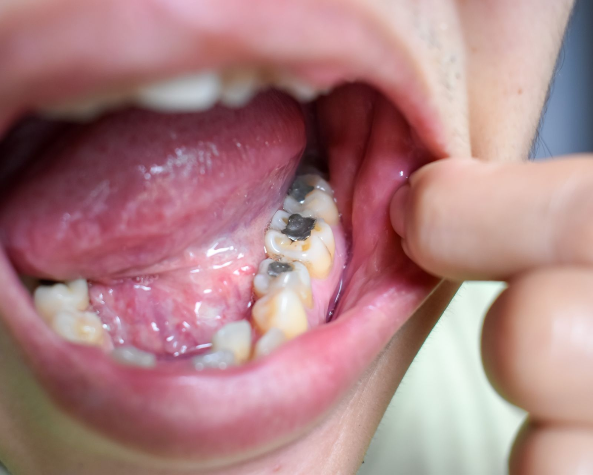 Mouth open, showing teeth with cavities, being pulled back by a finger.
