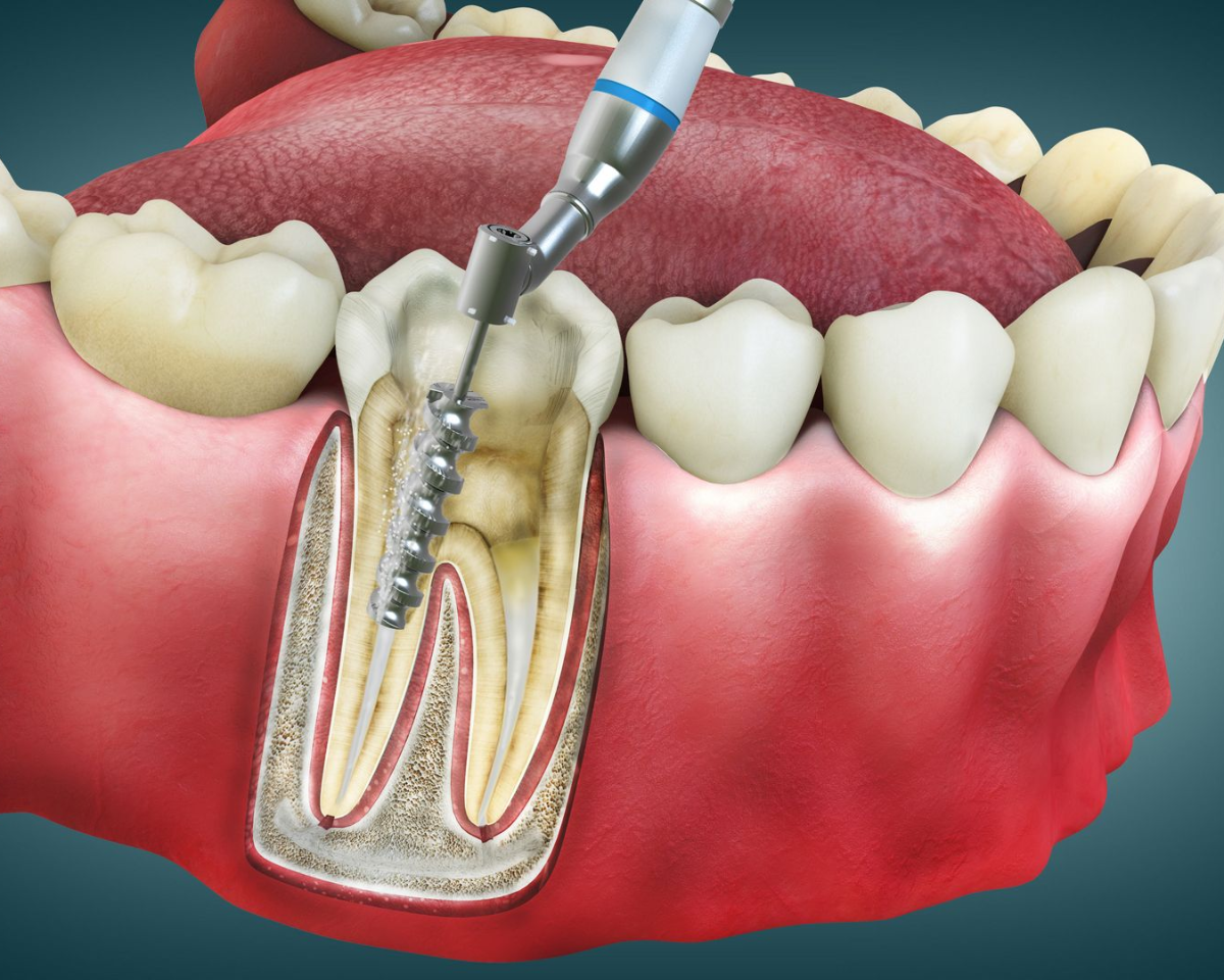Diagram showing root canal procedure on a tooth, with dental tool inside the root.