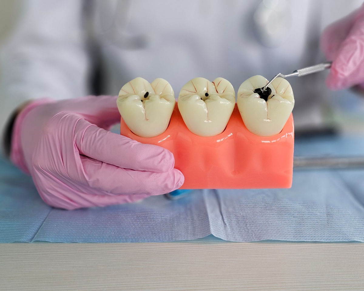 Dentist in pink gloves holding a model of teeth with cavities; white lab coat and dental tools visible.