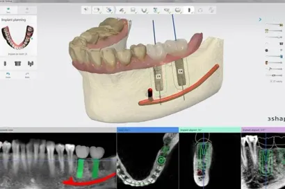 A computer screen shows a model of a dental implant