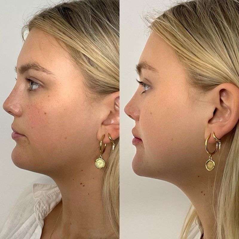Beautiful Girl On Lip Fillers Procedure — Lip Fillers in Wollongong
