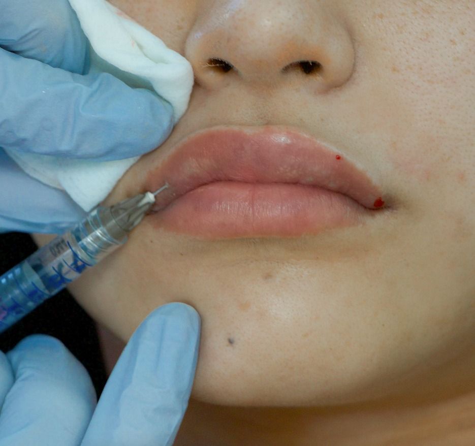 Woman During A Lip Filling Procedure — Lip Fillers in Wollongong