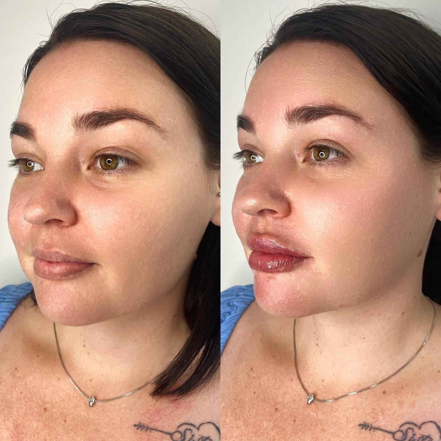 Close Up Image Of Lip Filling Procedure — Lip Fillers in Wollongong