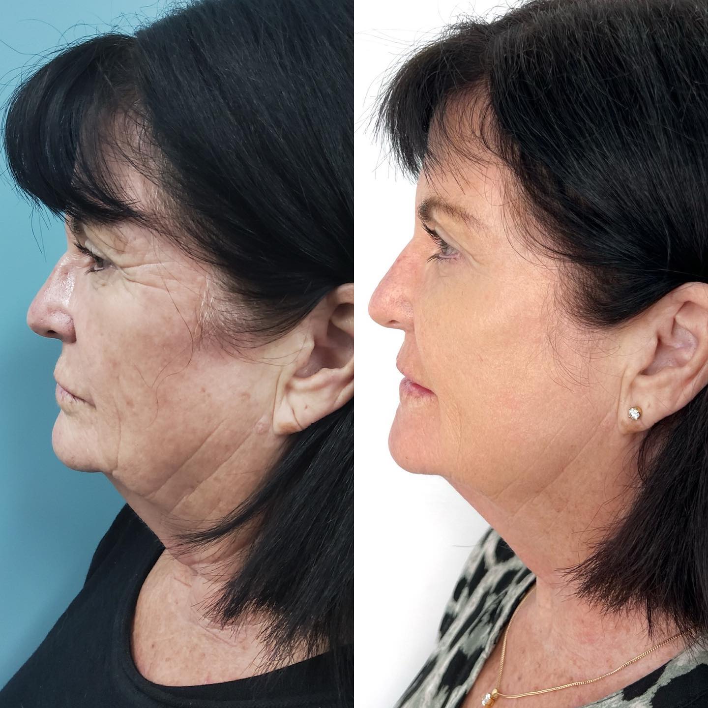 Before And After Photo Of A Woman from Wollongong Undergoing Anti-Wrinkle Injections