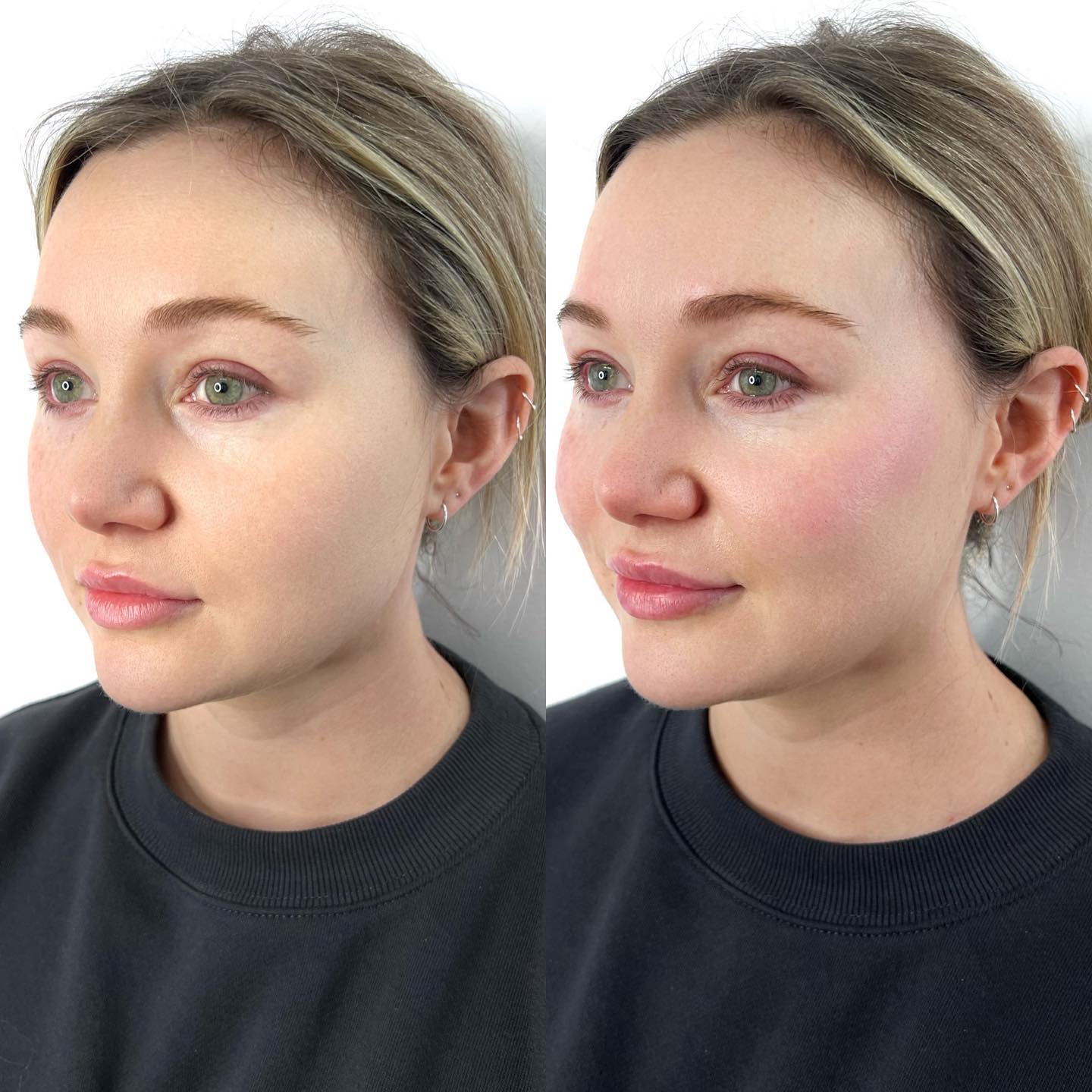 Before And After Photo Of A Woman After Cosmetic Rejuvenation Procedure — Cosmetic Clinic in Wollongong