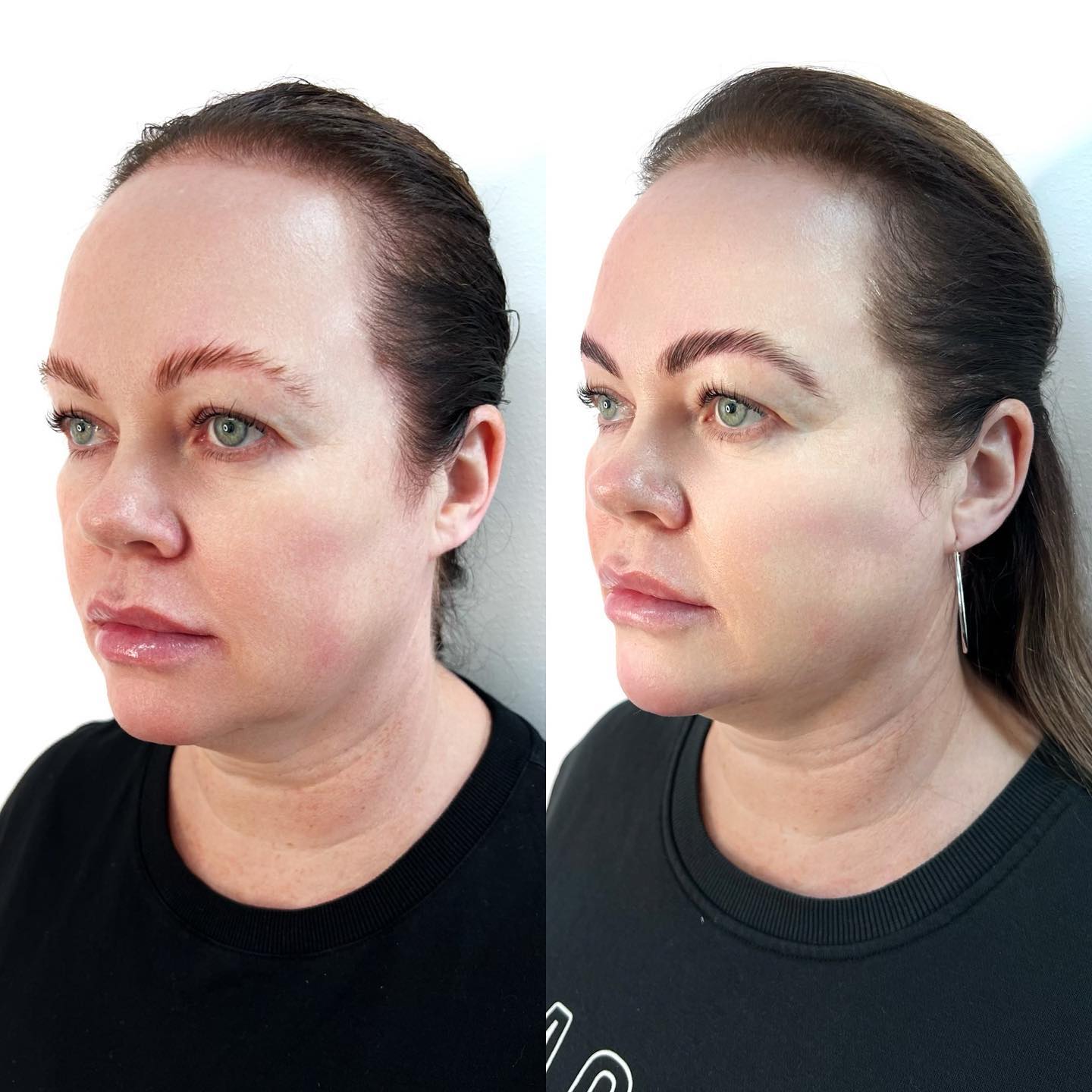 Comparison Photo Of Woman Before And After A Dermal Fillers Procedure In Wollongong