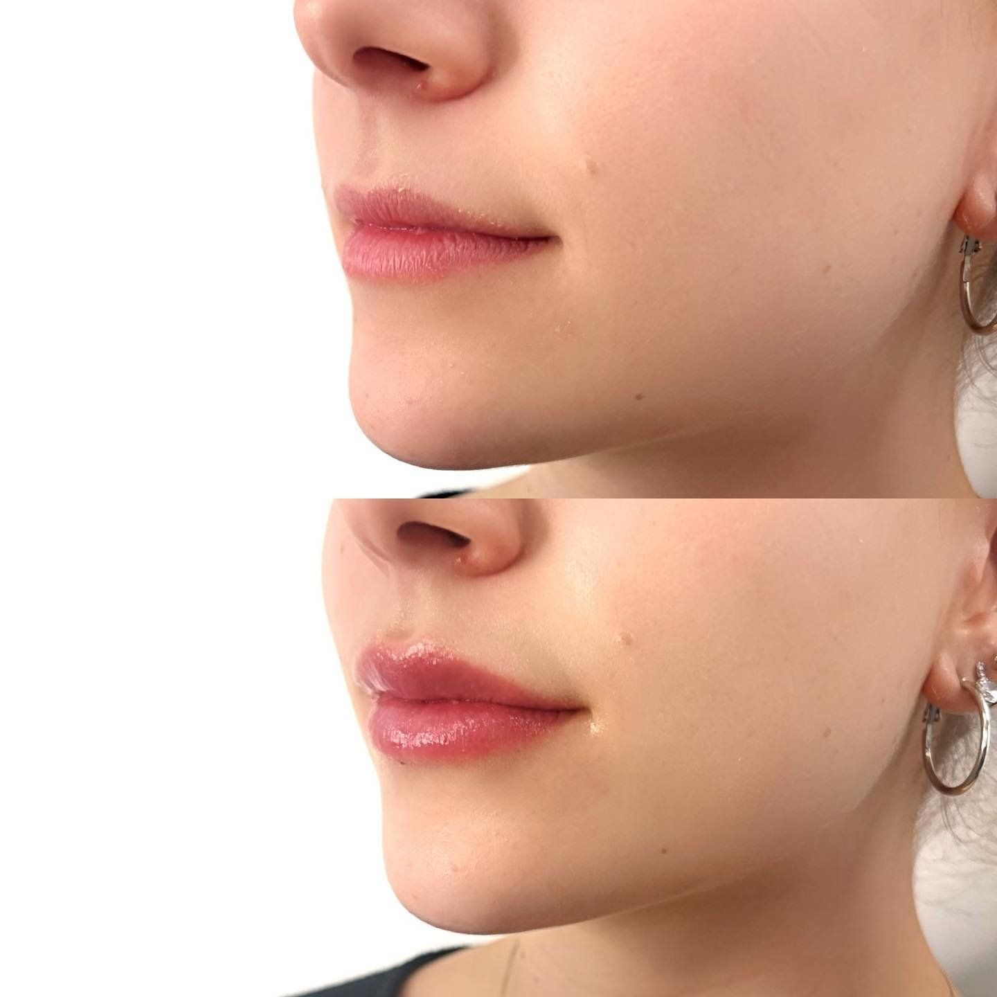 Woman's Lips Before And After Lip Filler Procedure — Cosmetic Clinic in Wollongong