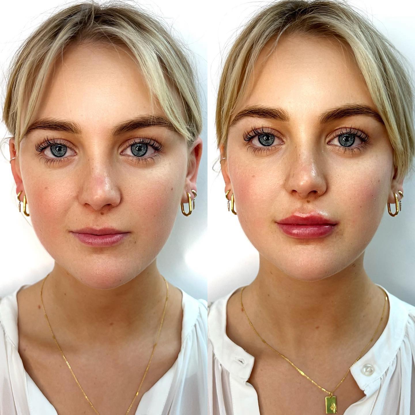 Blonde Woman Before And After Her Dermal Filler Appointment At Our Wollongong Clinic