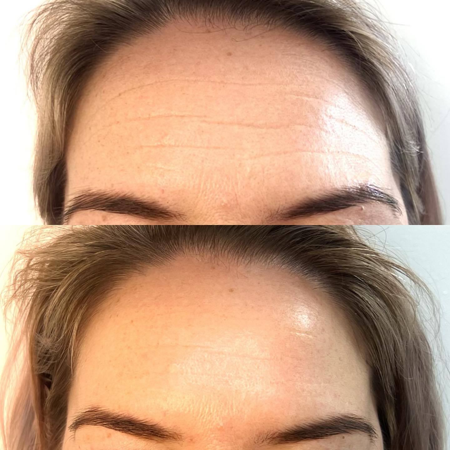 Before And After Photo Of Anti-Wrinkle Injection Procedure At Our Cosmetic Clinic in Wollongong