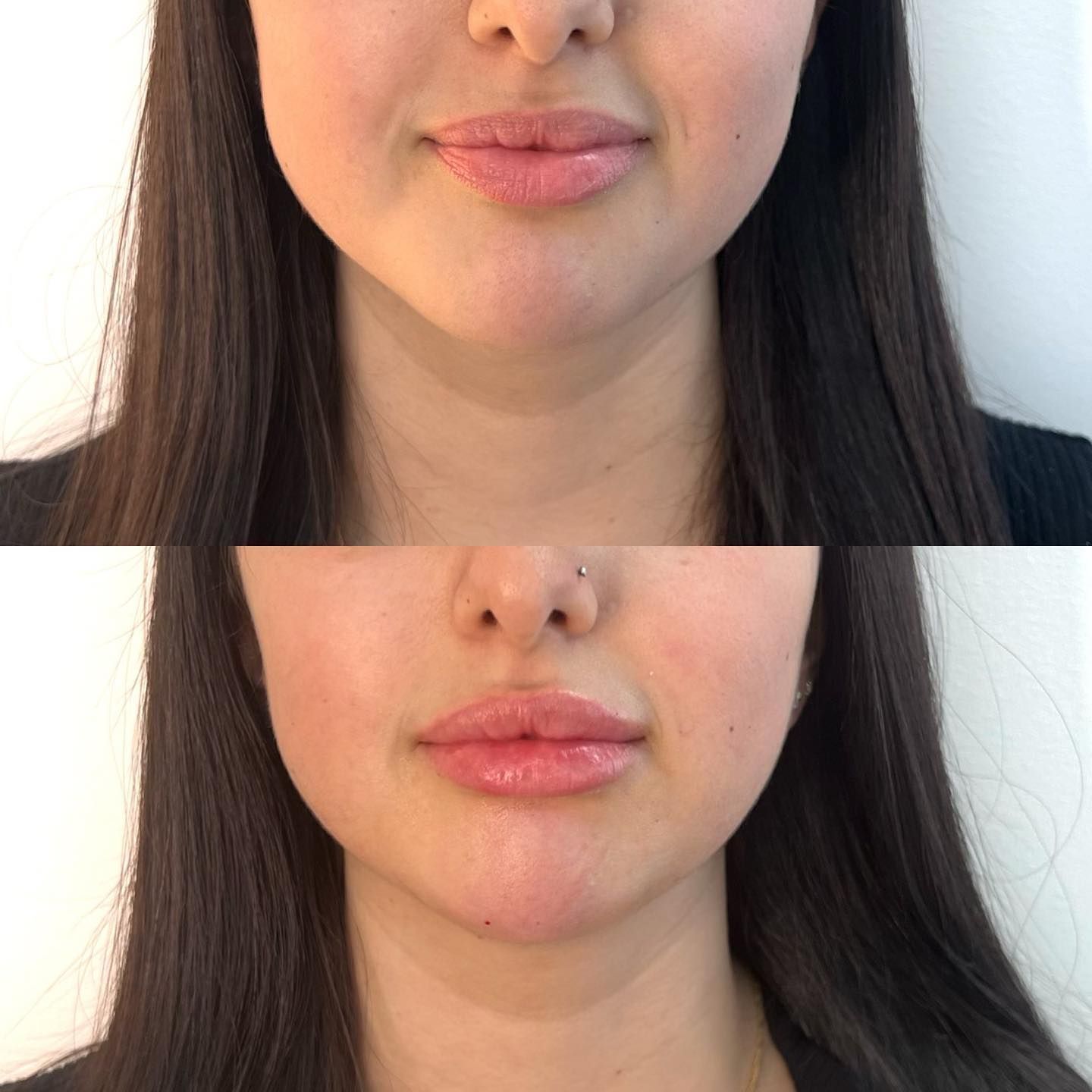 Woman Getting Beauty Injection For Lips — Lip Fillers in Wollongong