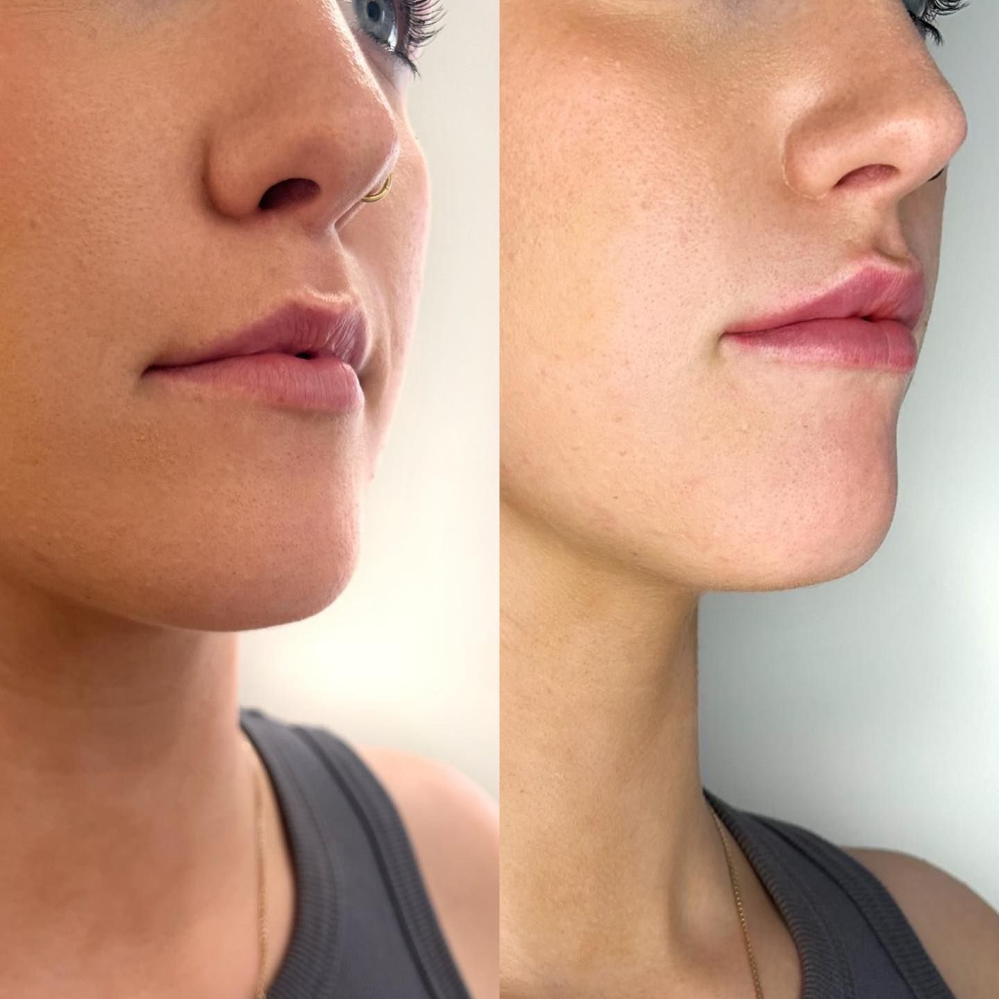 Specialist Applying A Lip Injection — Cosmetic Clinic in Wollongong