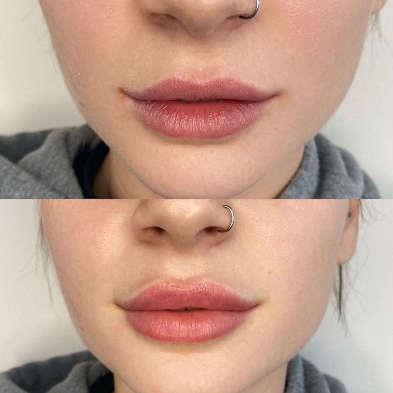 Young Woman With Plump Full Lips — Lip Fillers in Wollongong
