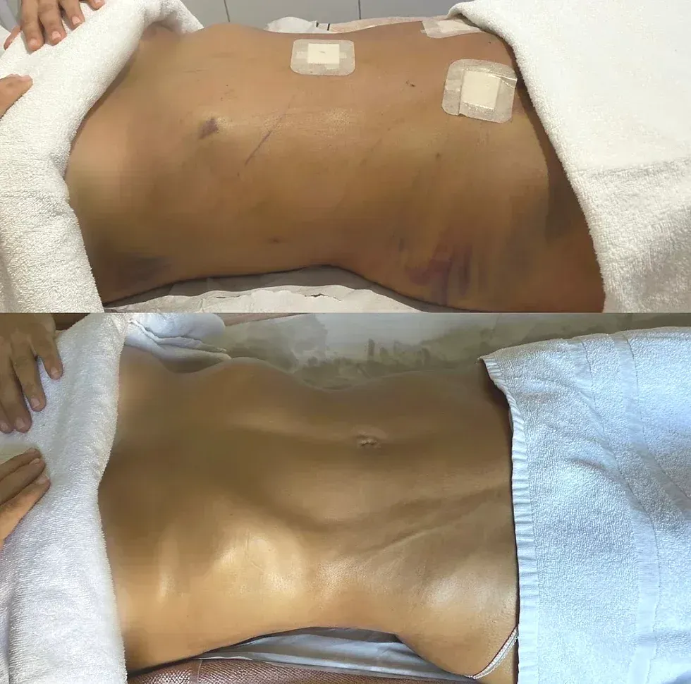 Top: Bruised abdomen after surgery with bandages. Bottom: Smoother abdomen with defined muscles.
