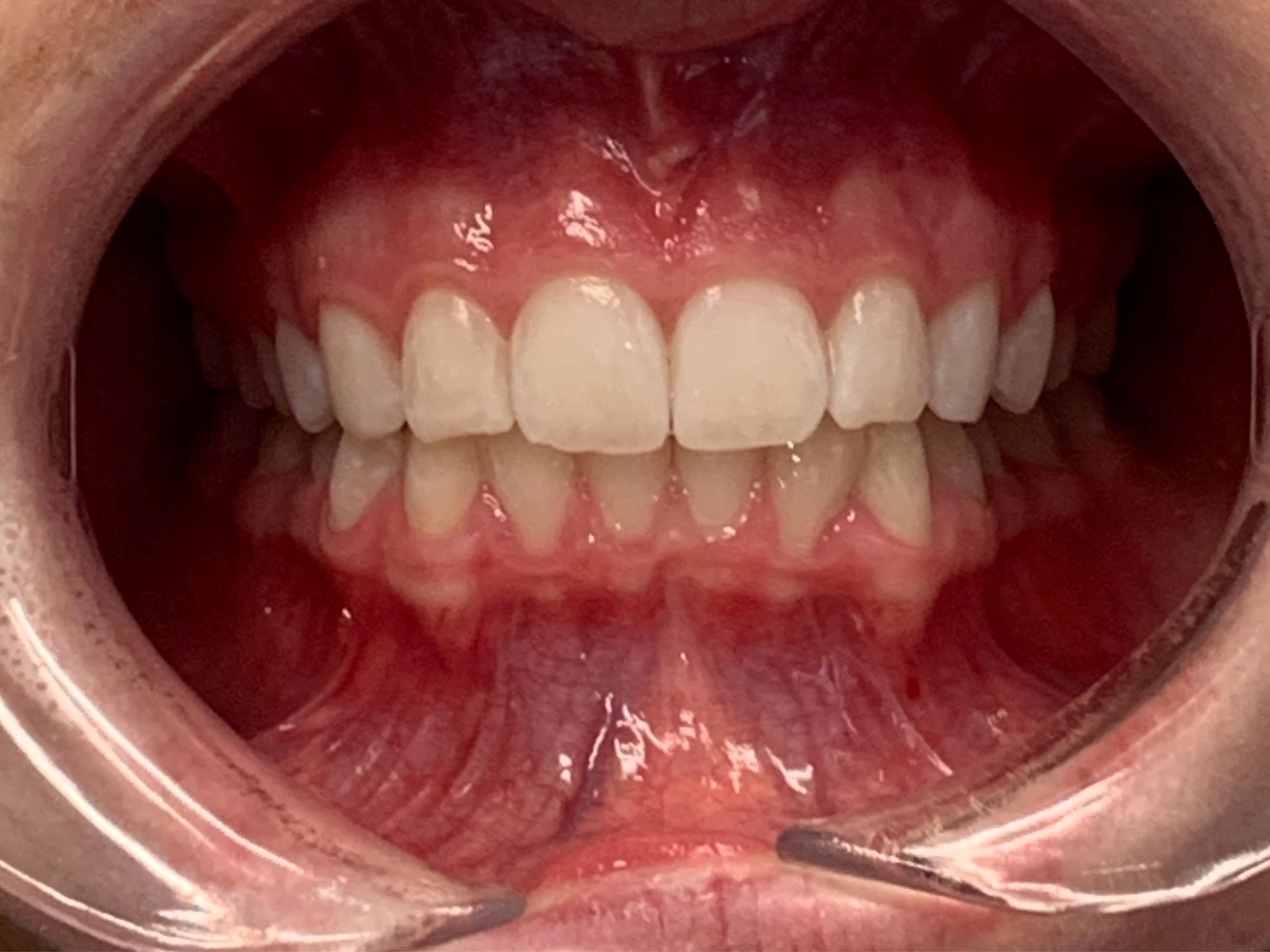 A close up of a person 's mouth with white teeth.