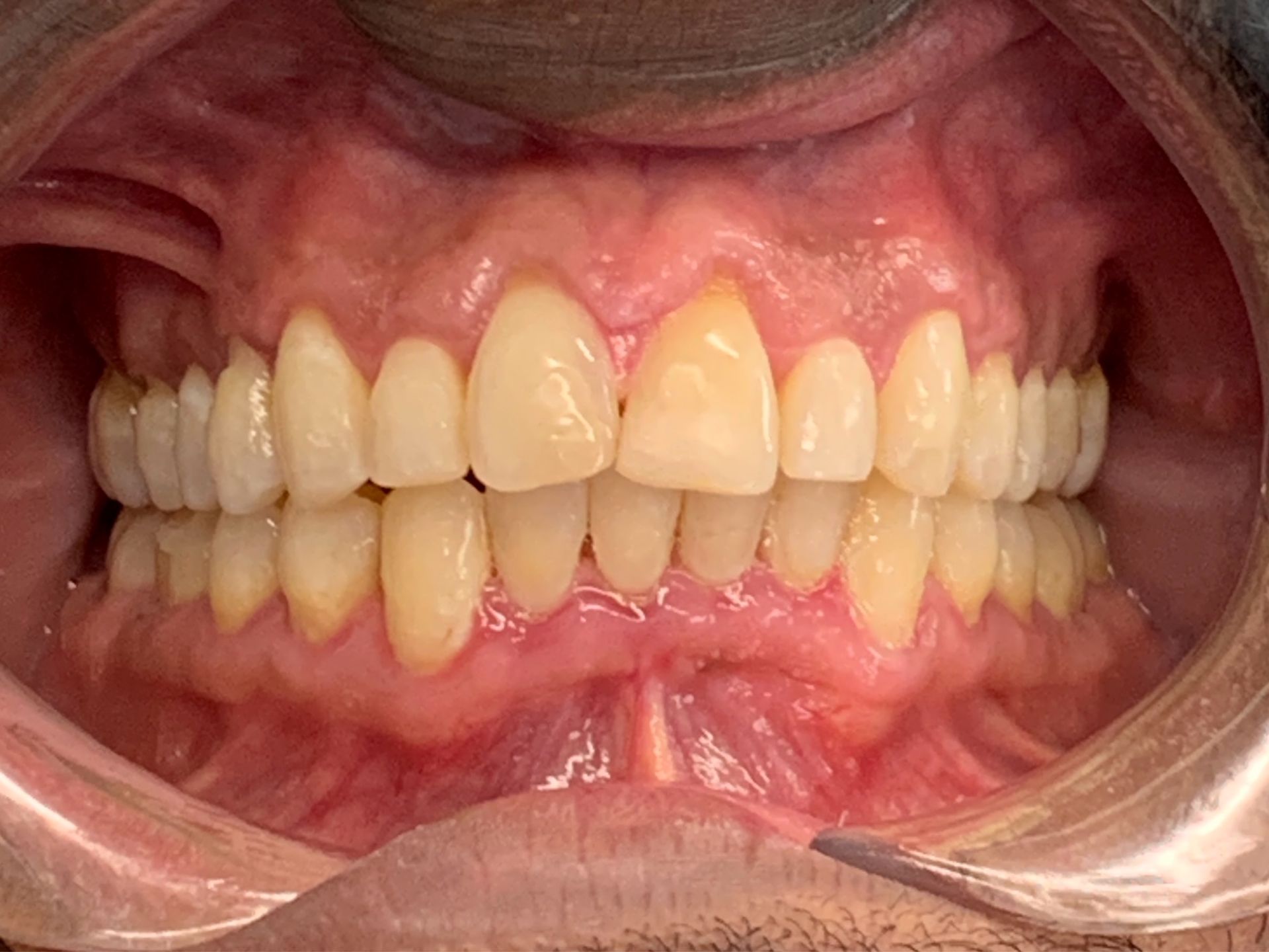 Invisalign Gap After