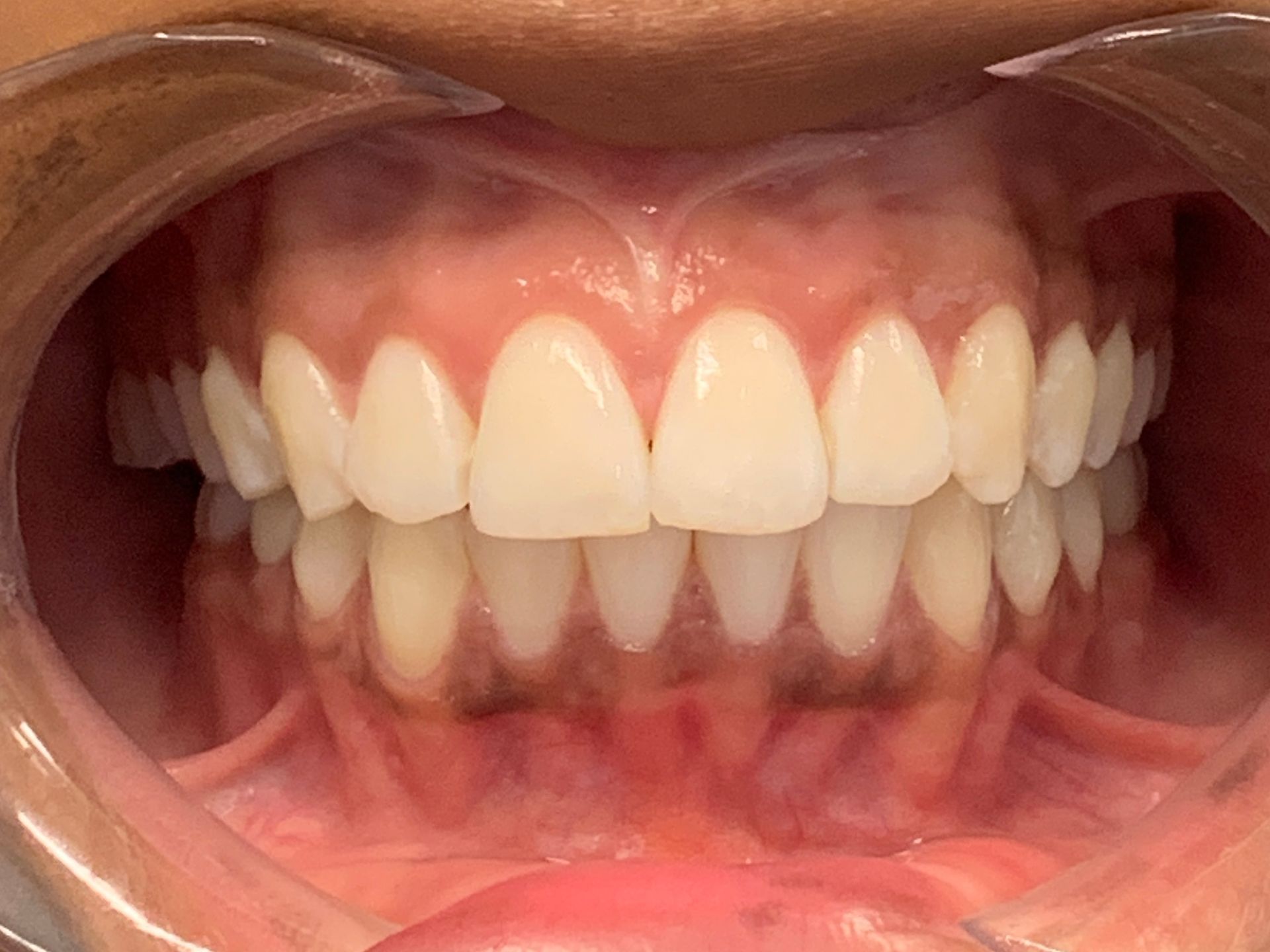 Invisalign Gap After