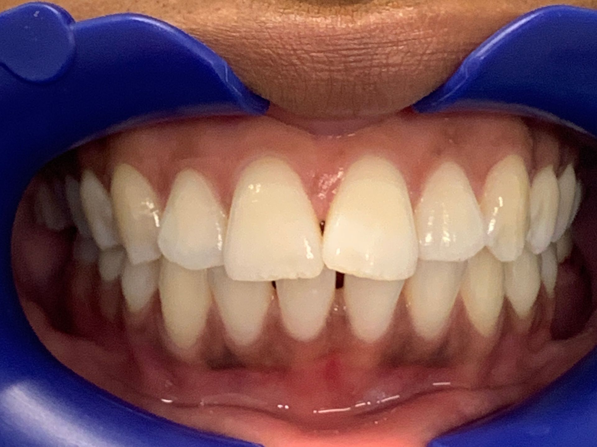 Invisalign Gap Before