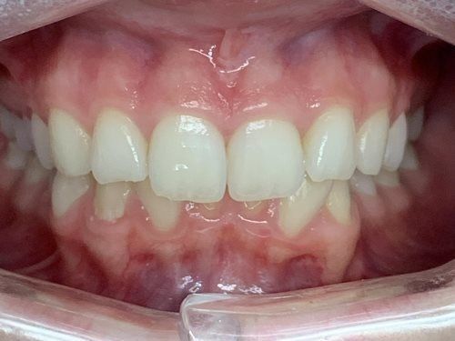 A close up of a person 's teeth 