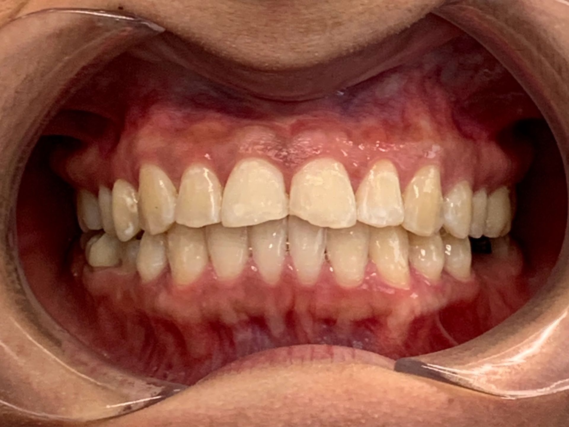 Invisalign Gap After